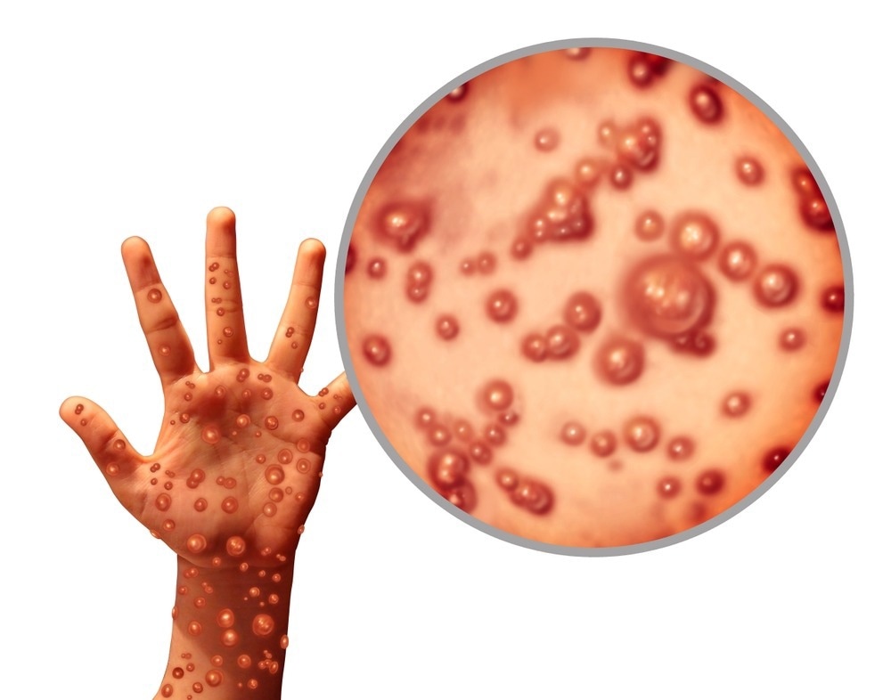 Study: Clinical Features and Novel Presentations of Human Monkeypox in A Central London Centre During The 2022 Outbreak: Descriptive Case Series. Image Credit: Lightspring / Shutterstock.com