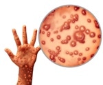 Symptoms of monkeypox differ from previous outbreaks