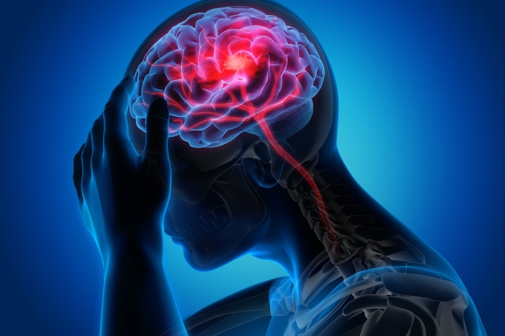 Migraine Concept
