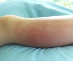 Cellulitis, a deep bacterial infection of the skin, as a monkeypox complication