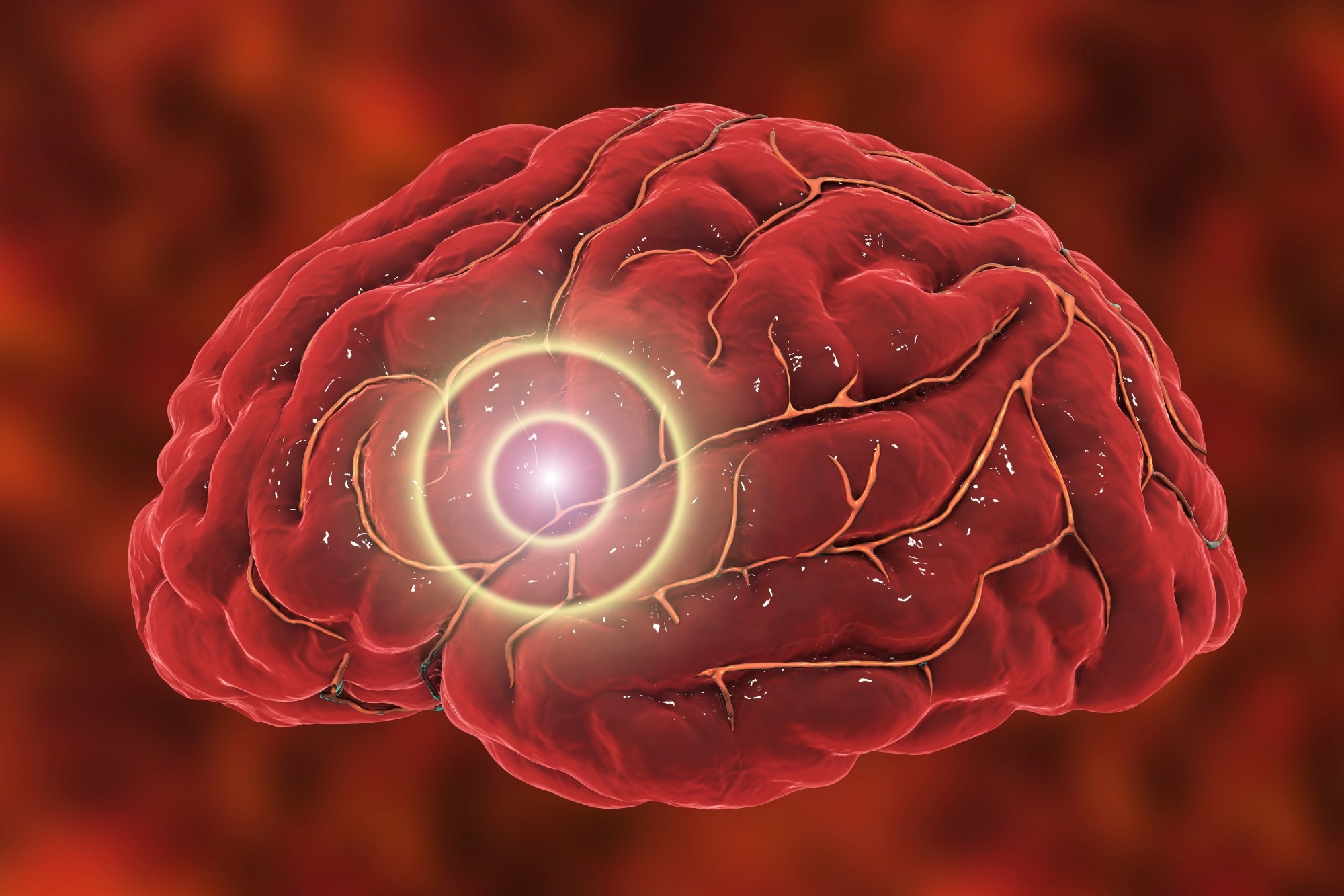 Study: Multiple ischemic stroke with pulmonary embolism revealing severe COVID-19 infection in a young healthy patient. Image Credit: Kateryna Kon/Shutterstock