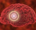 Multiple ischemic strokes and pulmonary embolism found in COVID-19 patient