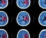 World Stroke Day 2022: Why saving #Precioustime is imperative