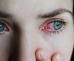 What are the eye complications associated with monkeypox infection?