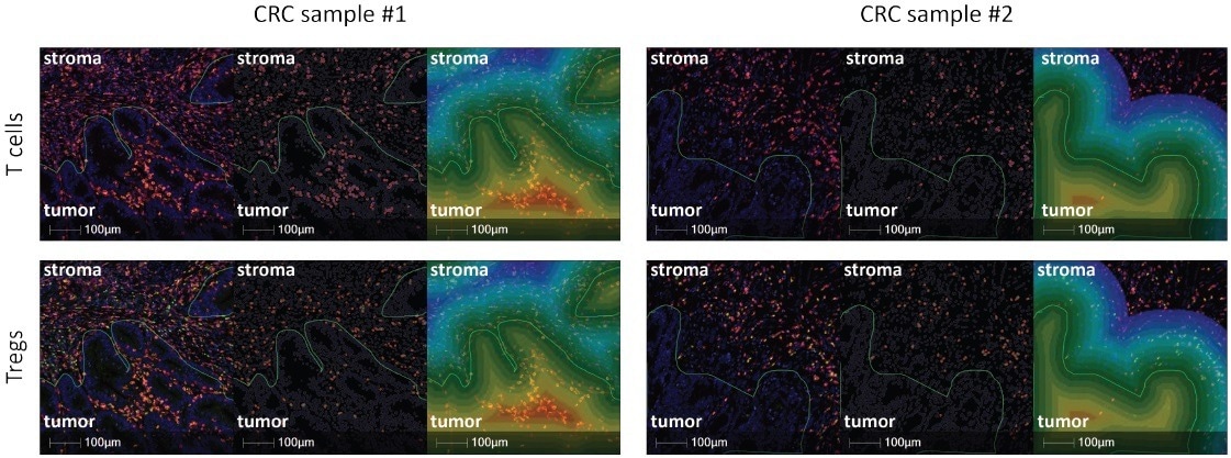Immunochemistry multiplex for solid tumor analytical validation
