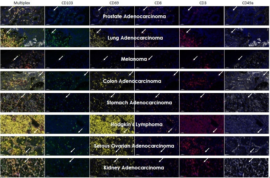 Analyzing regulatory and effector T cells in tumors