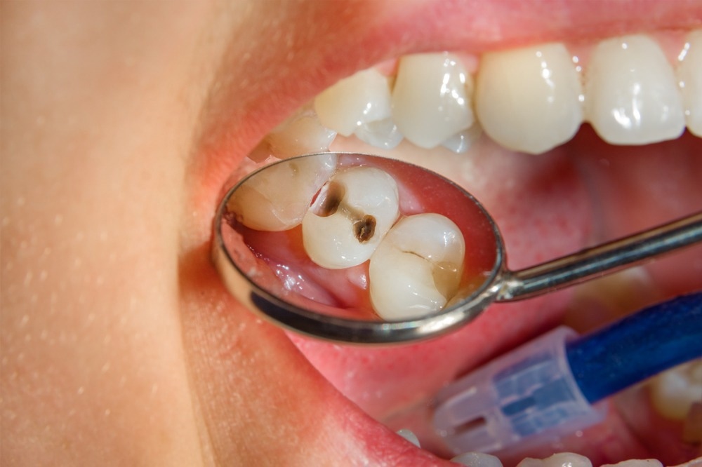 Study: A comparison of the caries risk between patients who use vapes or electronic cigarettes and those who do not: A cross-sectional study. Image Credit: Sergii Kuchugurnyi/Shutterstock