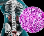 Two Cents' Worth: Shared decision making in renal cell carcinoma (RCC)