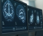 First cell-type specific multiomic study of the HIV brain