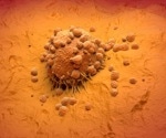 Metastatic Melanoma: key protein identified that aids the spread of skin cancer