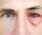 Study reports two cases of ocular MPox in HIV-infected patients