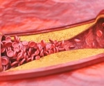 Investigating the association between lipid profile and coronary heart disease by race
