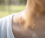 Using sweat to diagnosis disease: soft microfluidic analysis systems  assess health status