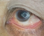 The role of caffeine in preventing diabetic retinopathy