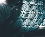 Therapeutic ketosis for mild cognitive impairment, Alzheimer's and Parkinson's