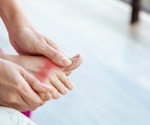 Study finds no association between gout and neurodegenerative diseases in the general population