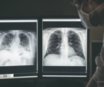 SARS-CoV-2 replication persists for weeks in lungs after symptom onset in severe COVID-19