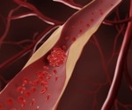 The relationship between intestinal microbiome dysbiosis and atherosclerosis