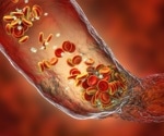 A randomized trial of a blood thinner after severe COVID-19 to prevent clotting events
