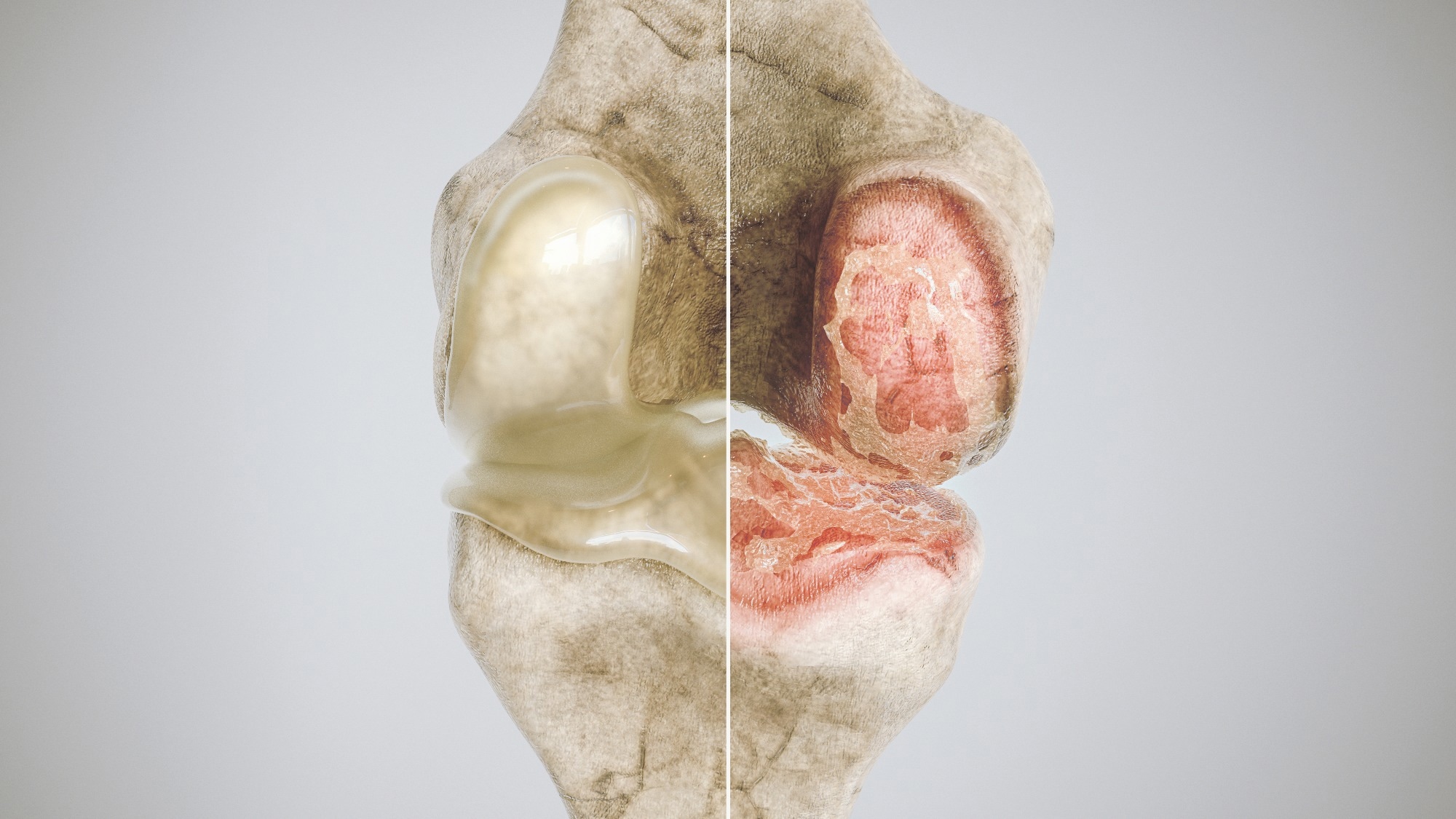 Study: Development of Osteoarthritis in Adults With Type 2 Diabetes Treated With Metformin vs a Sulfonylurea. Image Credit: Crevis / Shutterstock