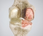 Metformin may reduce the risk of osteoarthritis