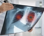 Study assesses the cellular and molecular immunopathology of post-COVID lung disease