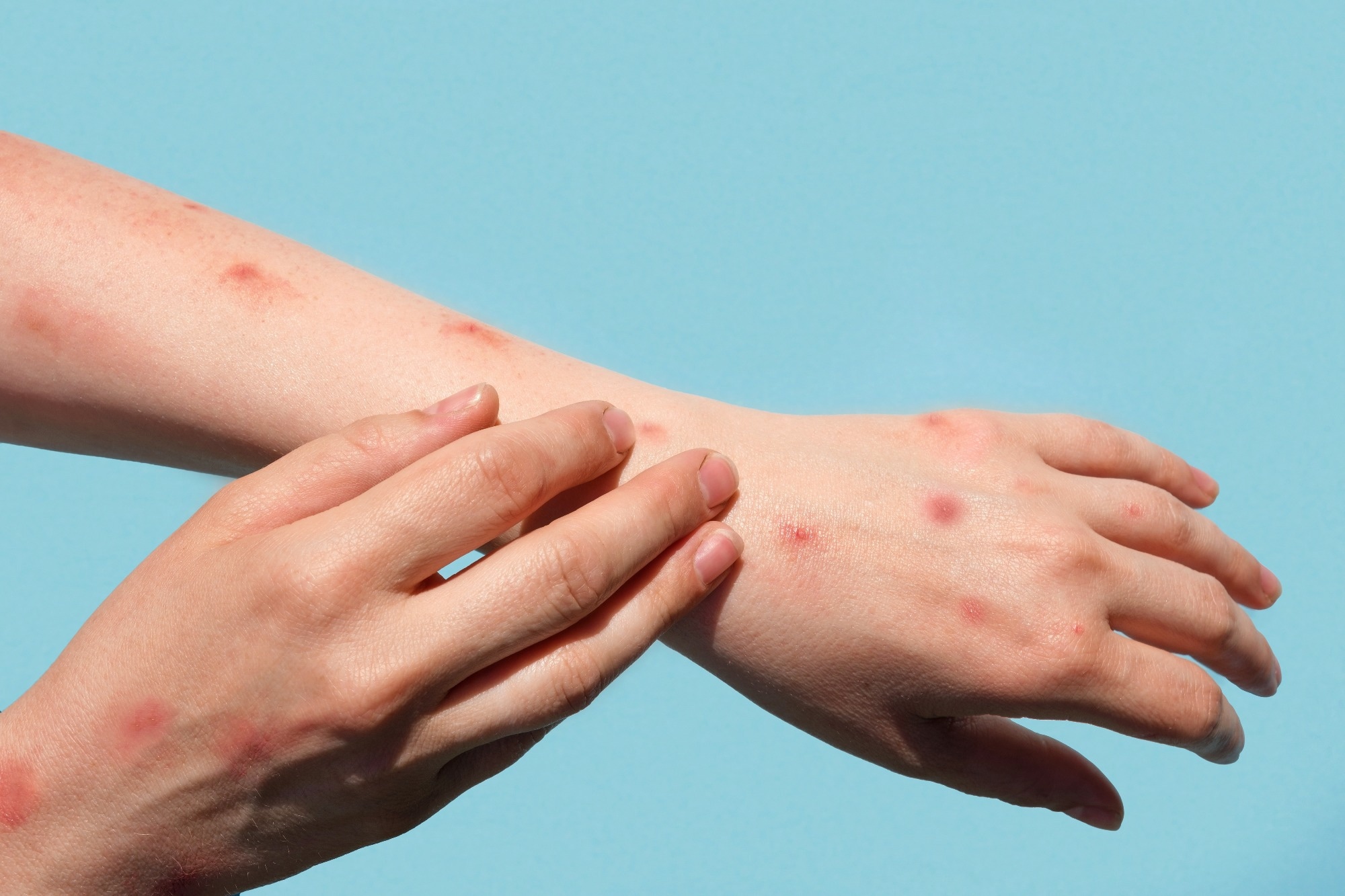 Study: T helper 1 effector memory CD4+ T cells protect the skin from poxvirus infection. Image Credit: MarinaDemidiuk/Shutterstock.com