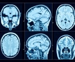 Gout unveiled as surprising culprit in neurodegenerative diseases