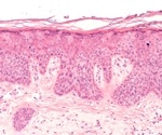 MFAP5, a microfibril-associated protein, unveiled as key player in scar formation and wound healing