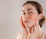 The genetics of neurogenic inflammation in rosacea