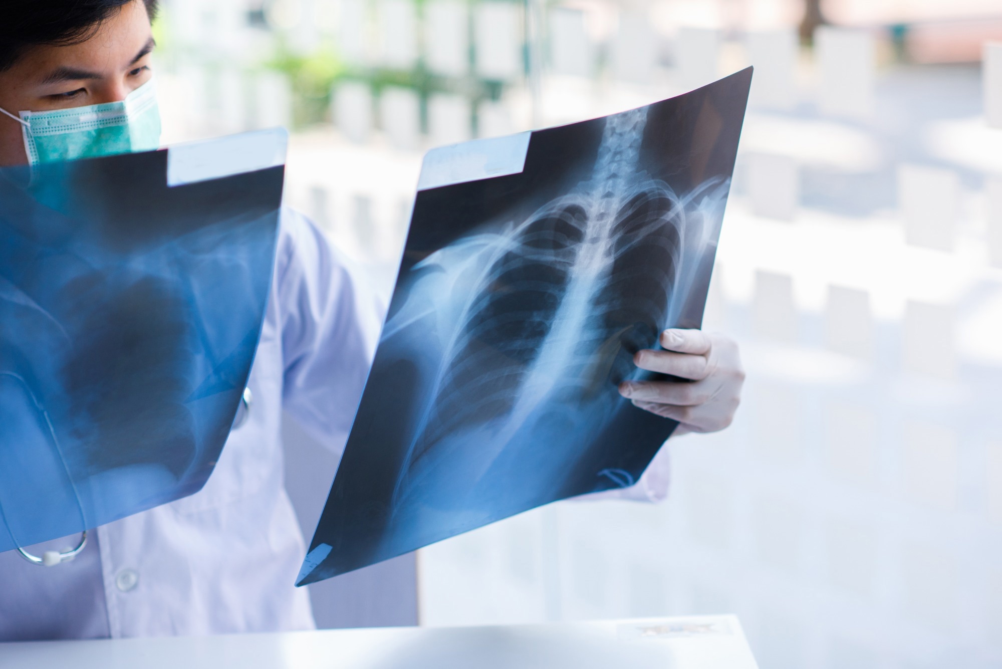 Identification of immune biomarkers in recent active pulmonary tuberculosis