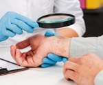 New targets for psoriasis treatment? Study reveals 165 associated genes