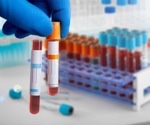 Study shows that anti-PTM antibodies are often present in autoimmune mediated liver disease