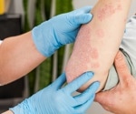 Can nutritional interventions positively impact psoriasis severity?
