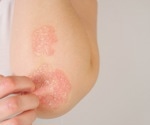 The causal effect of gut microbiota on psoriasis