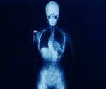 Can a validated deep learning model facilitate the diagnosis and management of adolescent idiopathic scoliosis?