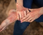Mediterranean diet supercharges skin treatment, clears up atopic dermatitis in teen