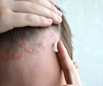 Multi-omics study offers insights into psoriasis treatment