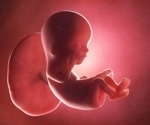 Placental disease: A key contributor to unexplained pregnancy loss