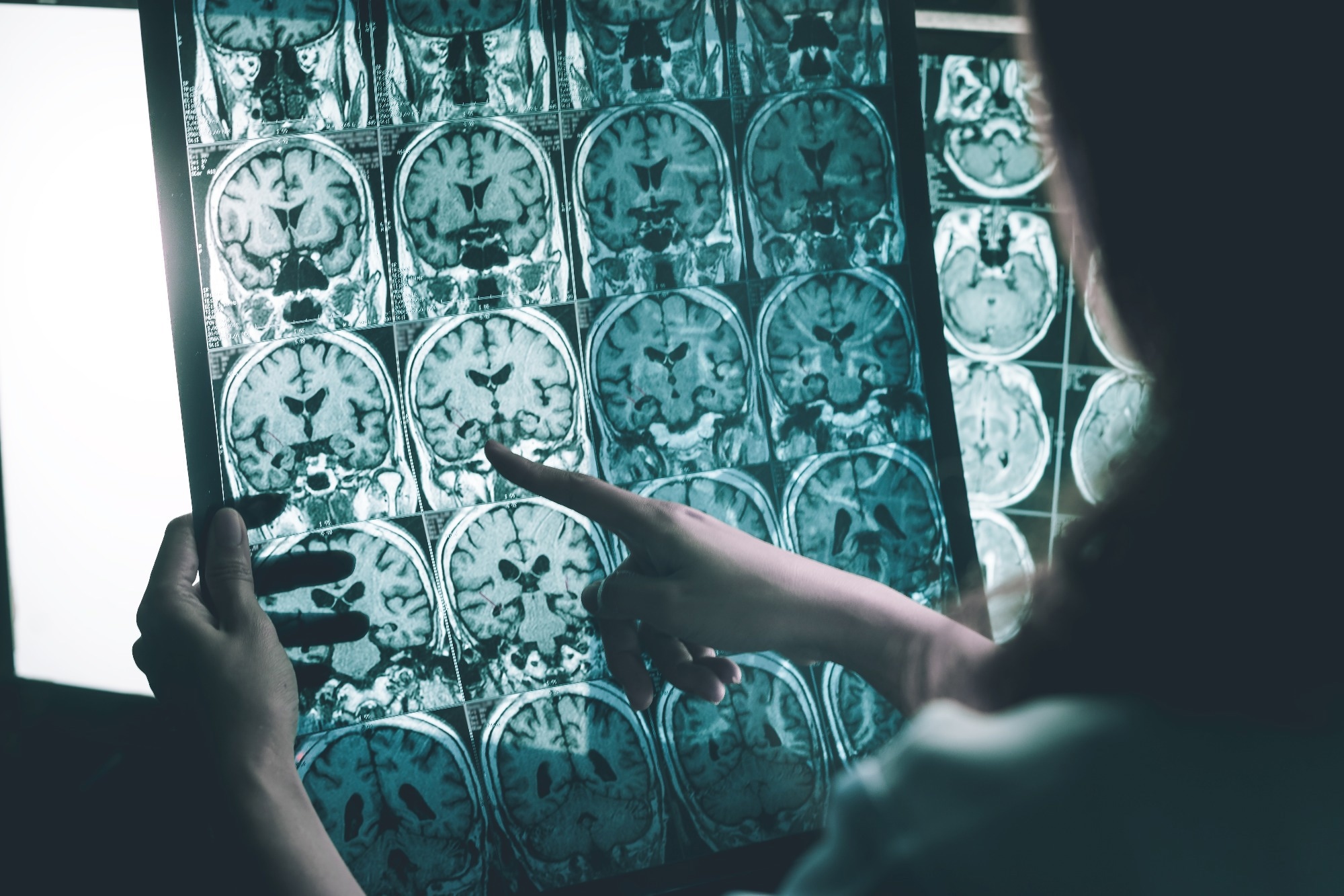 Study: MRI and Clinical Biomarkers Overlap between Glaucoma and Alzheimer’s Disease. Image Credit: Atthapon Raksthaput/Shutterstock.com