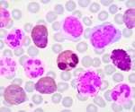 IL-17: The molecule that could revolutionize autoimmune and cancer treatments