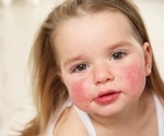 Balancing act: Navigating elimination diets in allergic kids without compromising nutrition