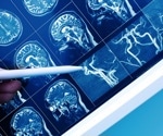 New study highlights urgent need for specific biomarkers in vascular cognitive impairment and dementia diagnosis