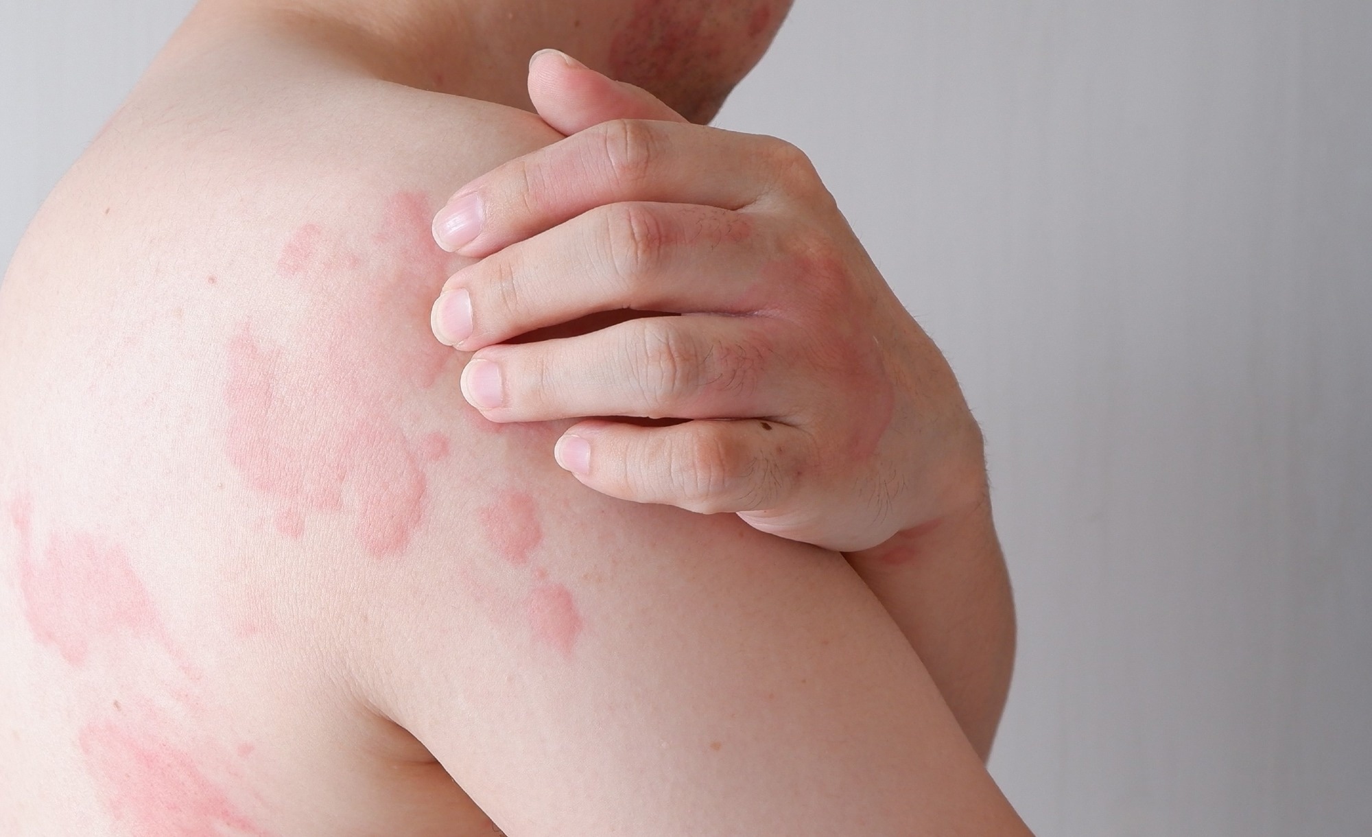 Study: Mathematical-based morphological classification of skin eruptions corresponding to the pathophysiological state of chronic spontaneous urticari. Image Credit: wisely/Shutterstock.com