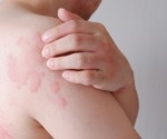 New study classifies CSU skin eruptions into five categories using mathematical modeling