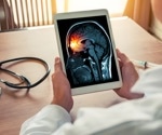 Varied early symptoms of bacterial meningitis in adults and children highlight diagnostic challenges
