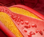 Global study emphasizes early detection of familial hypercholesterolaemia in youth