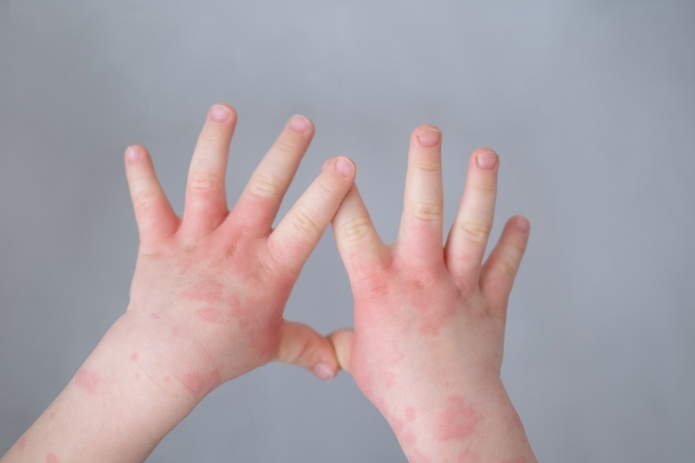 Study: Prenatal Opioid Exposure and Immune-Related Conditions in Children. Image Credit: Shevtsova Yuliya/Shutterstock.com