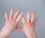 What is the association between prenatal opioid exposure and risk of immune-related conditions?