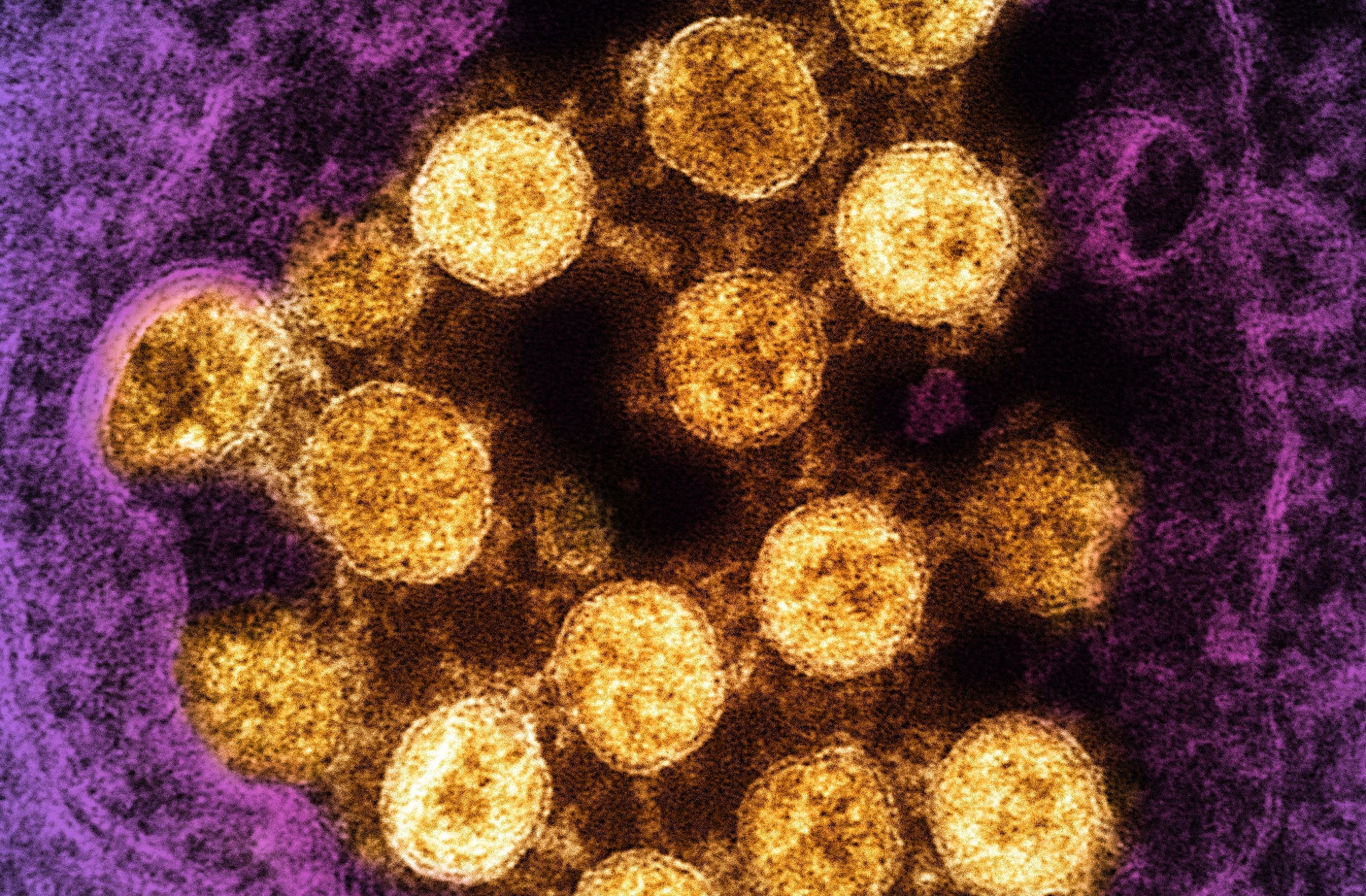 Study: Viral afterlife: SARS-CoV-2 as a reservoir of immunomimetic peptides that reassemble into proinflammatory supramolecular complexes. Image Credit: NIAID